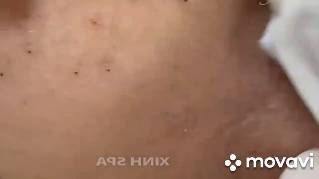 ОЧЕНЬ КРАСИВО Выдавливание Черных точек Самое залипательное видео выдавливание прыщей, ??