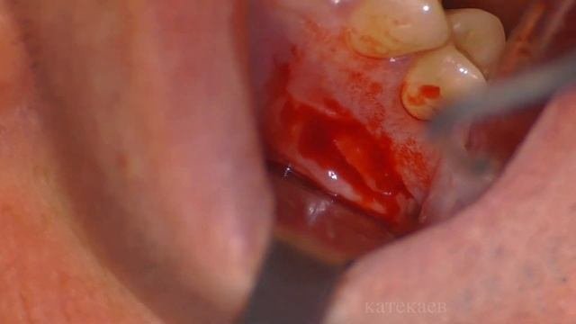 периостомия