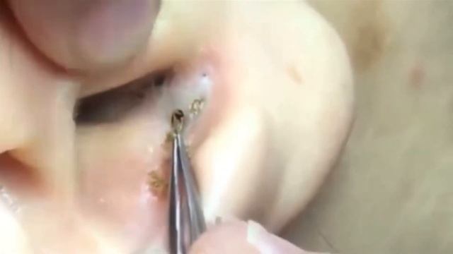 ОГРОМНЫЕ чёрные ТОЧКИ в ухе / УДАЛИТЬ / Blackheads on ear / REMOVAL