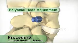 Спондилодез поясничного отдела позвоночника.