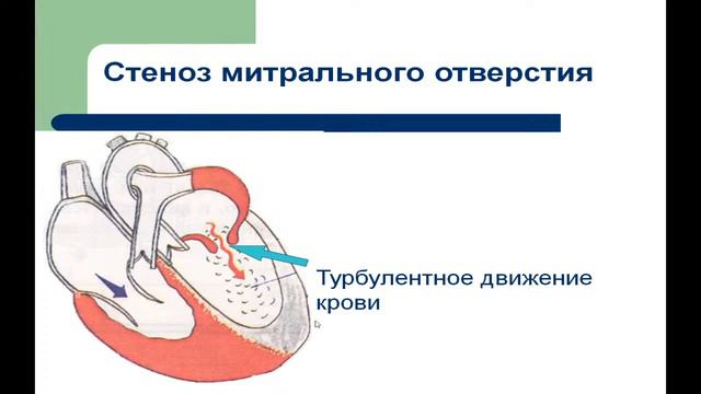 13:50 Приобретеные пороки сердца