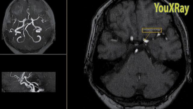 Анатомия магистральных артерий головного мозга на примере нативных МР-артериограмм. Виллизиев круг