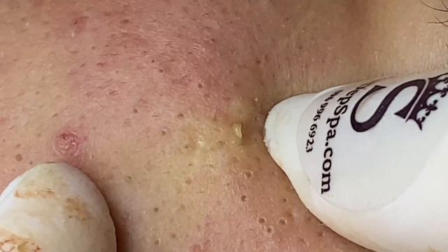 How To Remove A Blackhead | Cách Loại Bỏ Mụn Đầu Đen Nhanh Chóng - SacDepSpa#230