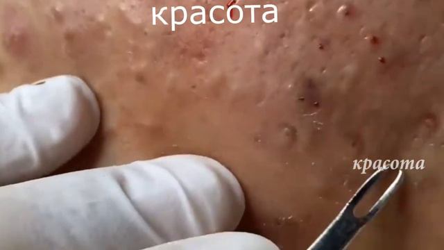 Удаление черных точек #01   Новое Выдавливание прыщей