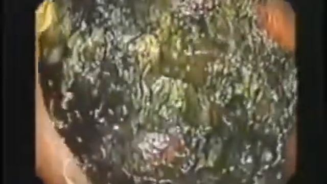 Кишечник изнутри. Здоровье и продолжительность жизни находится в кишечнике.