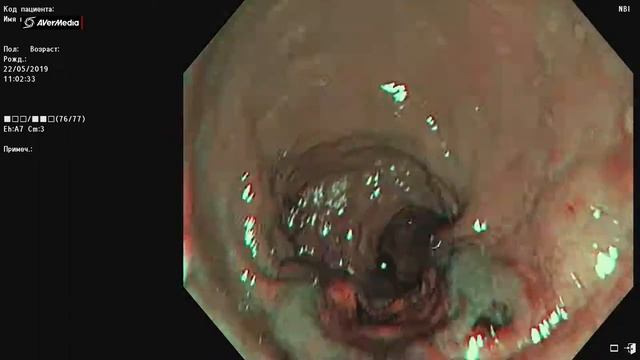 Колоноскопия. Опухоль прямой кишки.