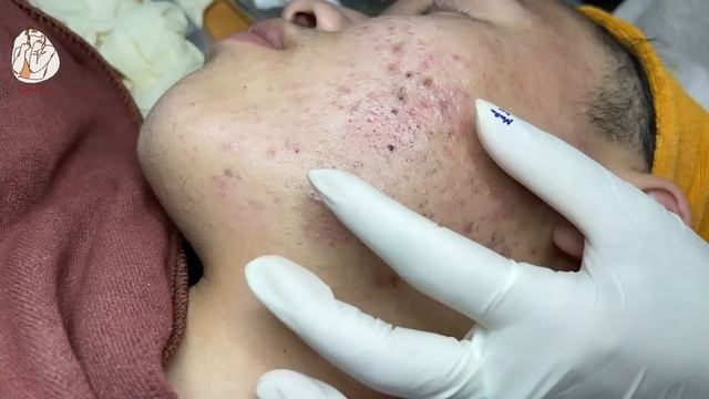 Remove Big Acne On Middle-Aged Men's Back