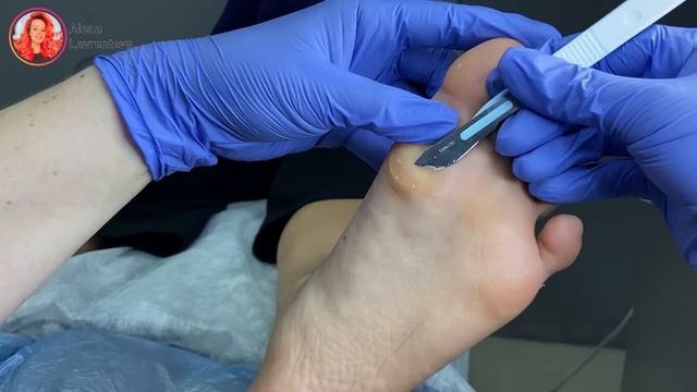 Натоптыши / Что такое натоптыши / что делать с натоптышем