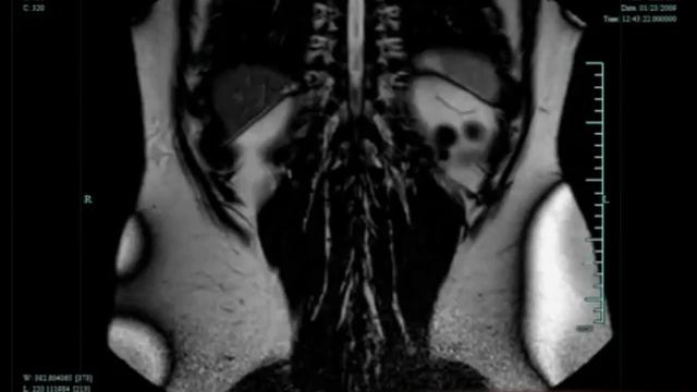 МРТ почек (томомография забрюшинного пространства)