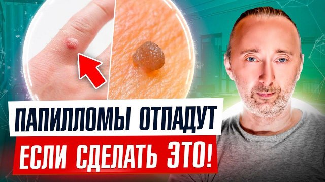 Папилломы и бородавки Вы уберёте за 2 дня ЭТИМИ простыми народными средствами, НАВСЕГДА!