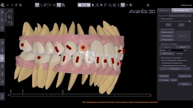 Новые возможности Avantis 3D. Орто Дизайн. Расстановка аттачментов.