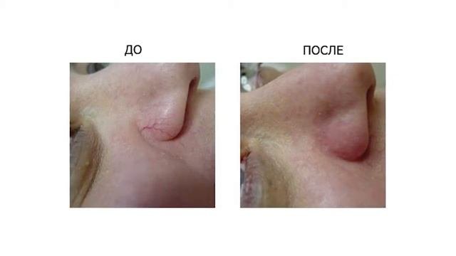 ЛАЗЕР