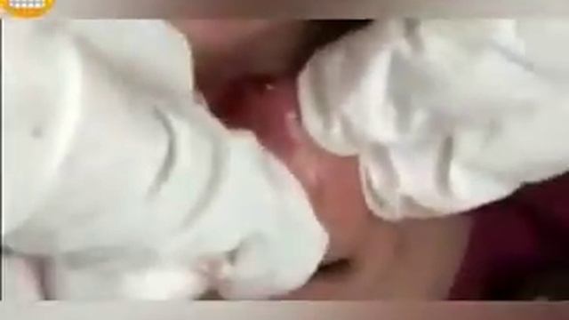 Выдавливание черных точек 
УГРИ - ПРЫЩИ НА ЛИЦЕ! (ДАВЛЮ) К