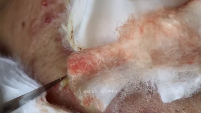 Suri Series 01: AMAZING INFLAMED BLACKHEADS POPPING | PART 3