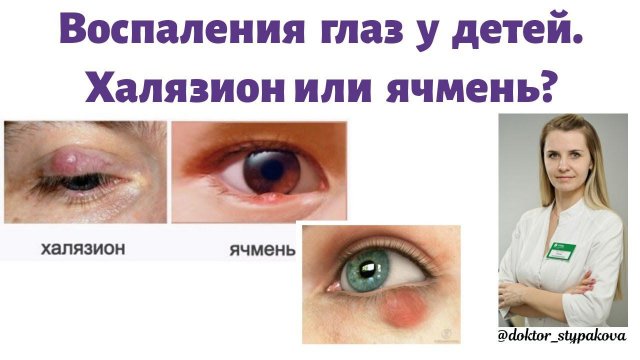 Воспаление глаз у детей.Халязион у детей.Как отличить халязион от ячменя?