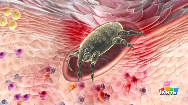 Летняя эпидемия: чесотка. Жить здорово! Фрагмент выпуска от 25.05.2018