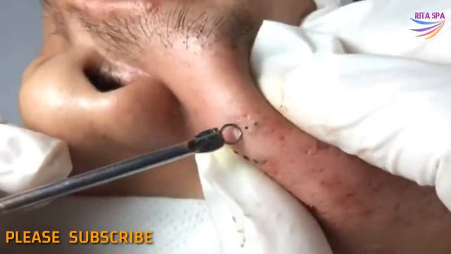 BLACKHEADS REMOVAL on face | how to get rid of blackheads & whiteheads   series acne treatment #020