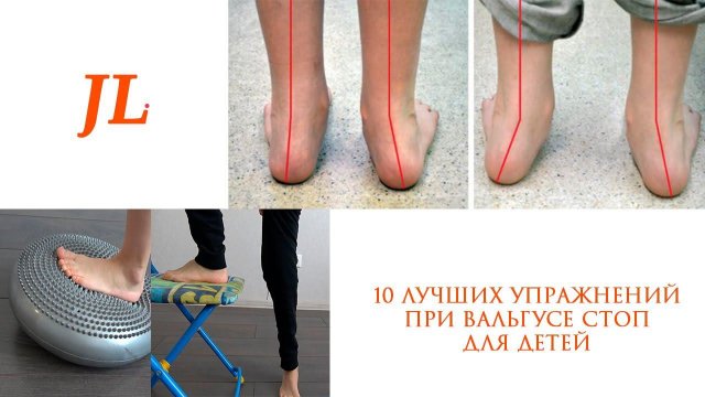 10 ЛУЧШИХ УПРАЖНЕНИЙ ПРИ ВАЛЬГУСЕ ДЛЯ ДЕТЕЙ