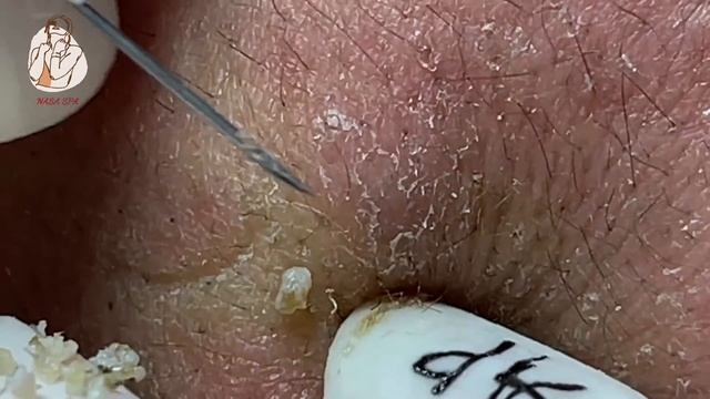 TREATMENT OF BLACKHEADS, HIDDEN ACNE IN THE MOUTH