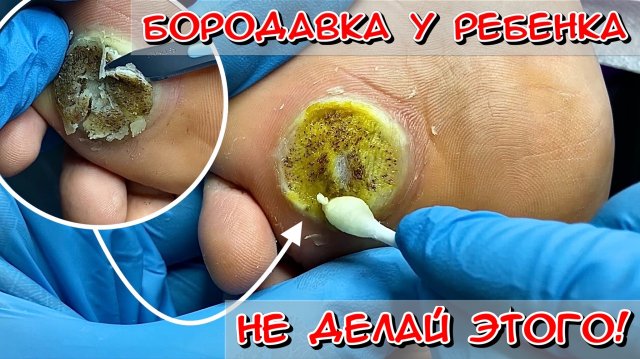 Бородавка у ребенка / не делай этого!