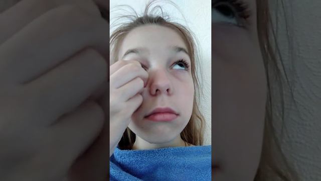 кровь из глаз