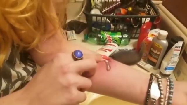 МНОГО ГНОЯ! Выдавливание прыщей