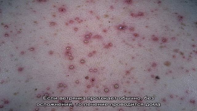 Ветрянка у детей: причины, симптомы, лечение, профилактика