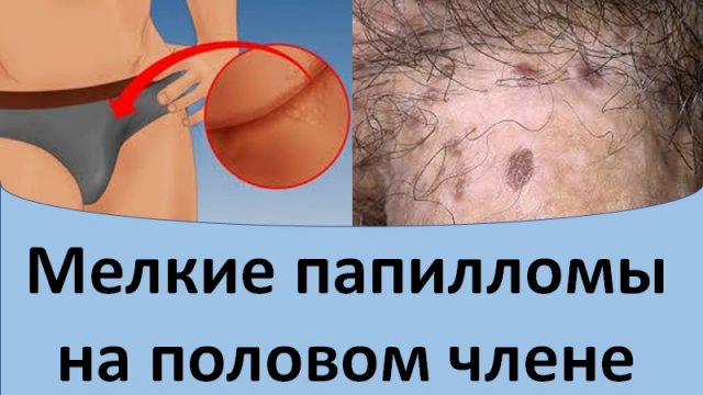 Мелкие папилломы на половом члене