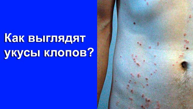 Как выглядят укусы клопов?