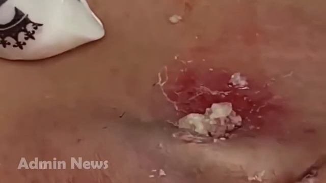 Relax squeezing out blackheads #50 Черные точки