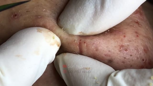 AWESOME POPPING BLACKHEADS FIELD | Suri Job 130