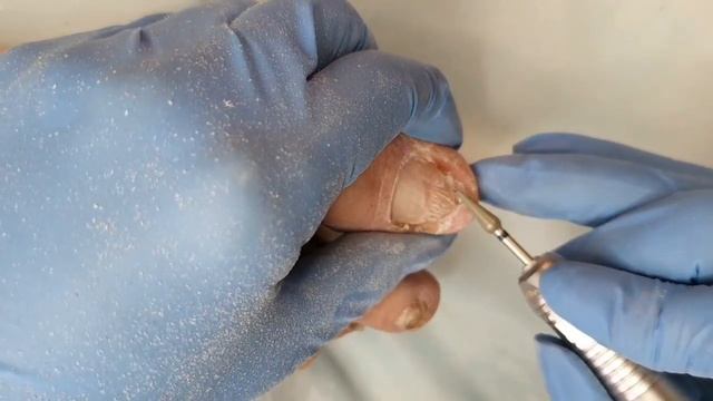 Медицинский педикюр. Аппаратная обработка ногтей. Онихомикоз.