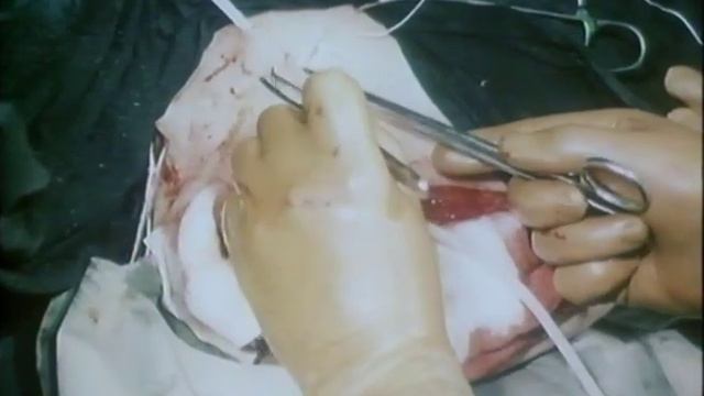 Активное хирургическое лечение гнойных ран