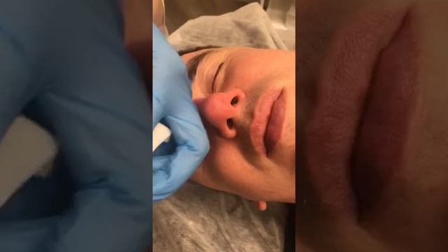 Удаление камедонов на носу