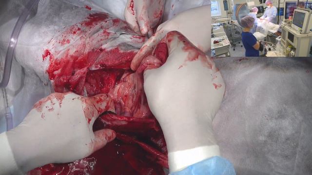 Удаление новообразования в брюшной полости