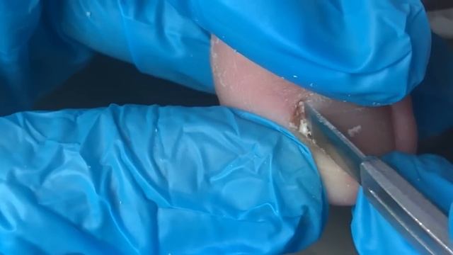 Trim off the onychomycosis layer by layer!【Crazy pedicure room】