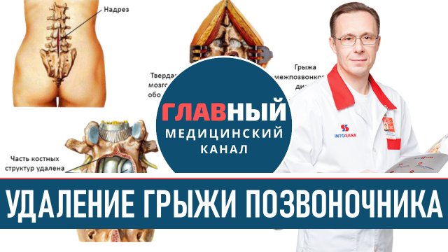 Удаление Грыжи Позвоночника и реабилитация. Лечение межпозвоночной грыжи поясничного отдела