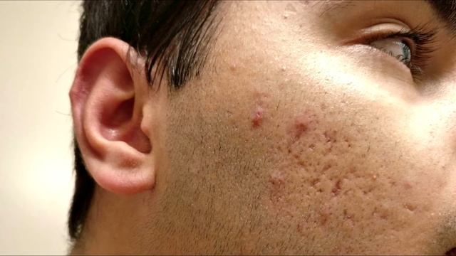 Почему нельзя давить прыщи и что будет если давить прыщи на лице