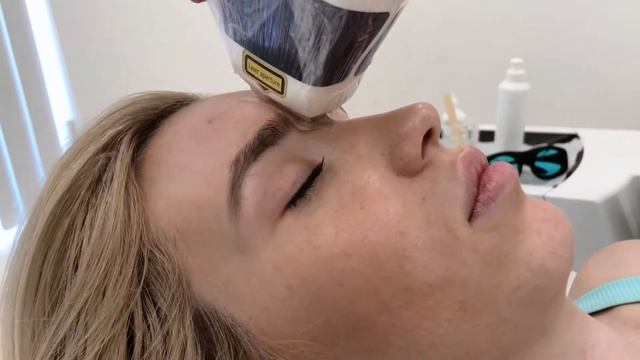 Лазерная эпиляция межбровья