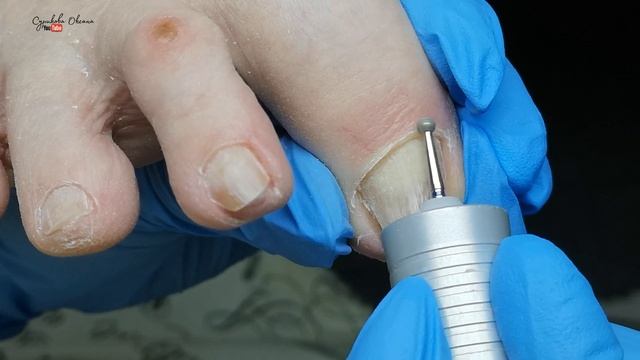 Толстые и скрученные ногти на ногах. Аппаратный педикюр: обработка пальцев ног. Ремонт ногтя акрило