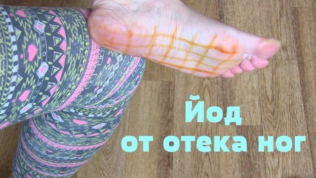 Как избавиться от ОТЕКА НОГ с помощью йода.