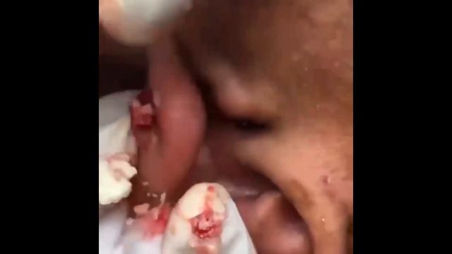 Выдавливание прыщей/акне/жировиков. Часть 2 | Squeezing out pimples / acne / wen. Part 2