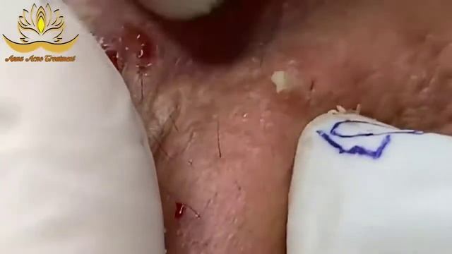Удовлетворительное видео с угрями и прыщами. появляются прыщи и черные точки 2