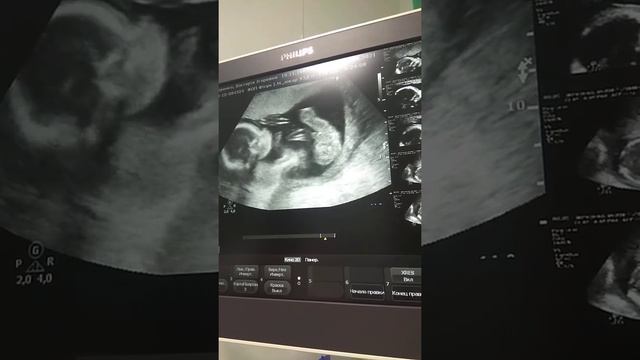 УЗИ 19 недель( второй скрининг)10.08.21