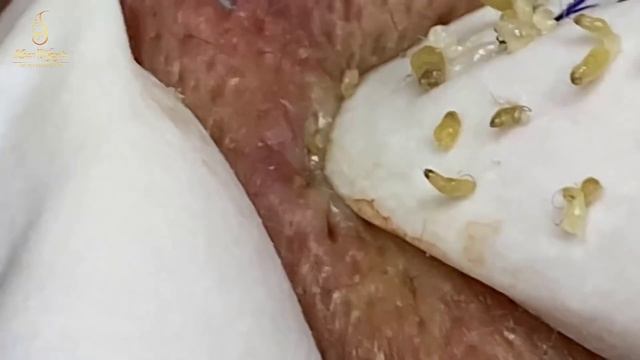 The small blackheads grains of rice | Loan Nguyen