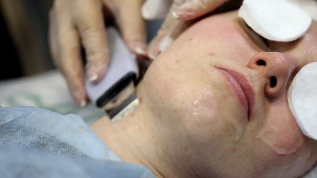 Ультразвуковой пилинг клиенту с чувствительной кожей лица