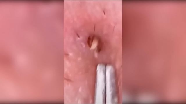 Popping huge blackheads and Pimple Popping - Best Pimple Popping Videos #15