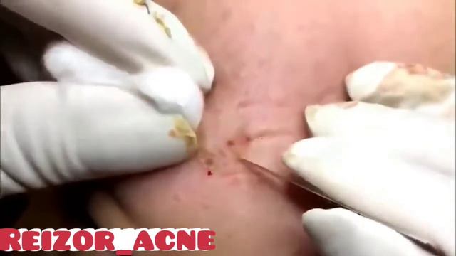 Removes acne, Давим прыщи, чёрные точки. Залипательно 2021
