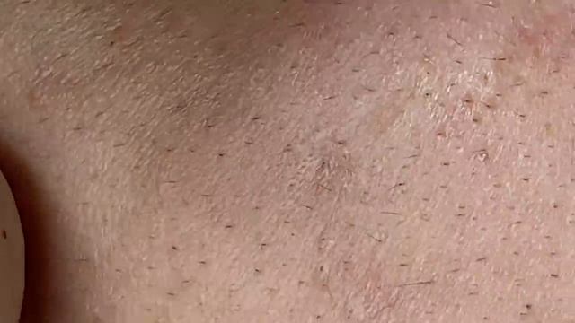 Захватите прыщи, скрытые глубоко под кожей