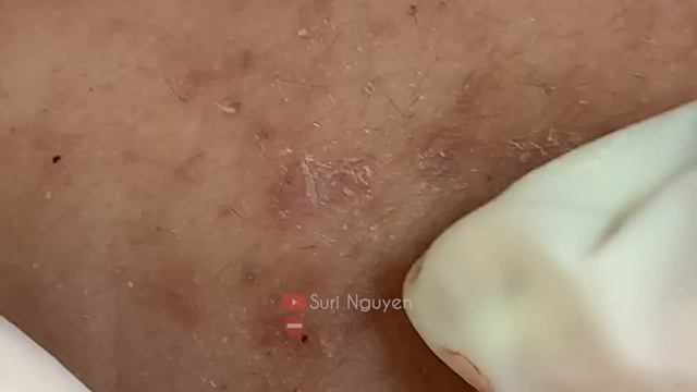 Suri Job 675: Awesome Blackheads Extraction